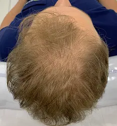 Queda masculina avançada antes